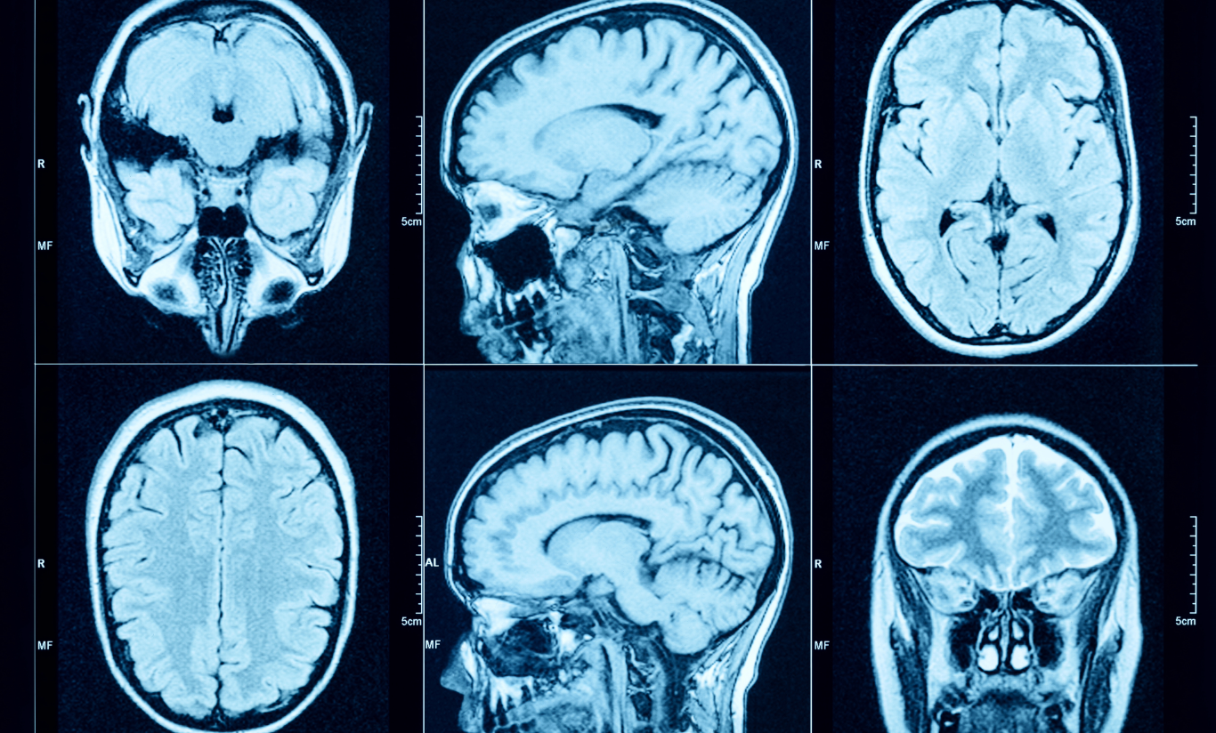 Traumatic Brain Injury (TBI)